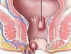 痔疮的治疗方法有那些？