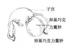 东莞长安卵巢性不孕的易发人群