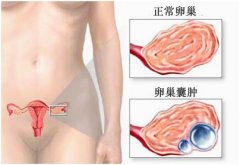 诊断卵巢囊肿治疗