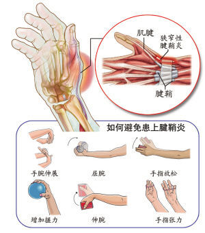 湘潭腱鞘炎治疗哪家医院好