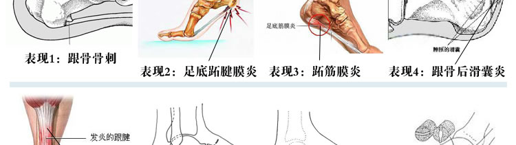 足跟韧带损伤发炎致发：绝大多数的脚后跟疼痛都是由于韧带发炎引起的。当人行走时，巨大的牵拉力集中在跟骨下面韧带上一个狭窄的区域内，反复的牵拉摩擦容易导致韧带和骨骼结合部位发炎，造成疼痛。 