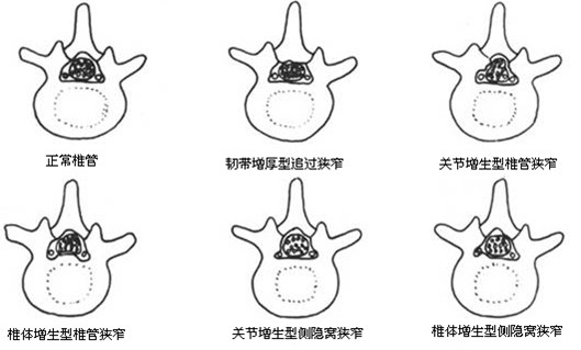 腰椎管狭窄的治疗费用