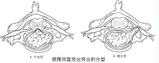 湖南颈椎间盘突出的治疗费用哪里 便宜