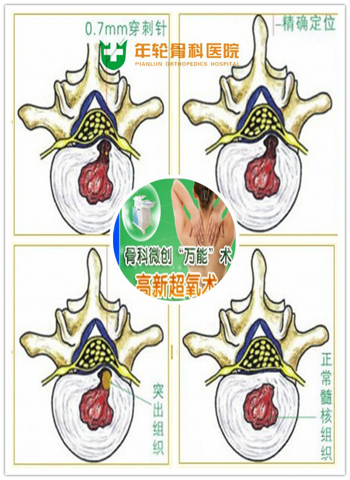 微创治疗是医学上治疗颈椎间盘突出 新的技术，在临床上广为使用，治疗效果也是目前屈手可指的技术。对于颈椎间盘突出各类型病情轻重皆为适宜，效果好，安全。