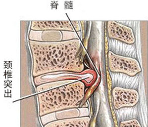 颈椎间盘突出的治疗费用